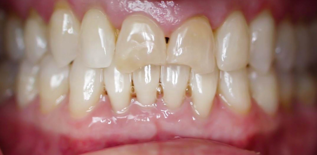 Full dentures by Tacoma Cosmetic Dentist - the Before photo