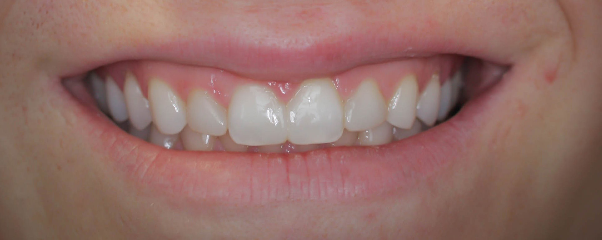 Esthetic bonding to fix small chips and gaps -- the After picture