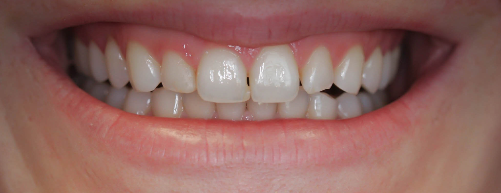 Esthetic bonding to fix small chips and gaps -- the Before picture