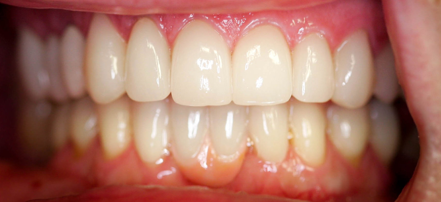 Esthetic makeover using veneers, crowns and bridges - the After photo