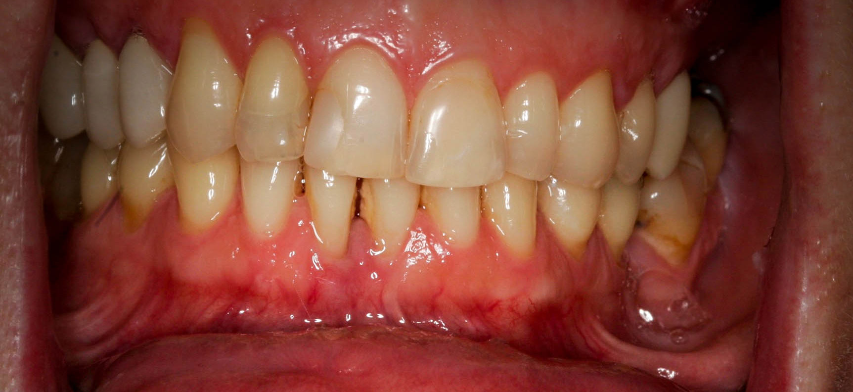 Esthetic makeover using veneers, crowns and bridges - the Before photo