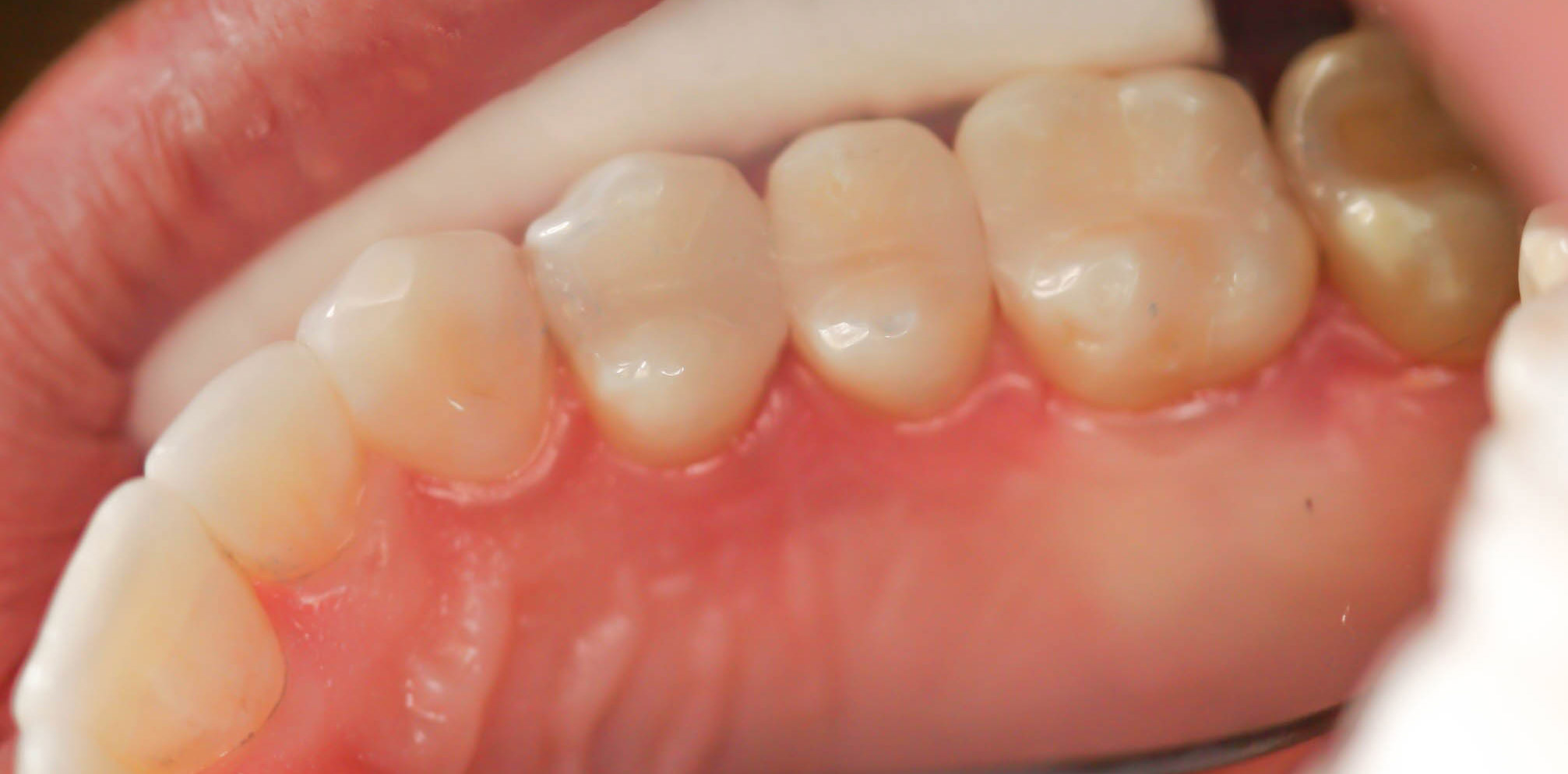 Safe amalgam or mercury filling removal and replacement with biocompatible tooth colored fillings -- the After picture