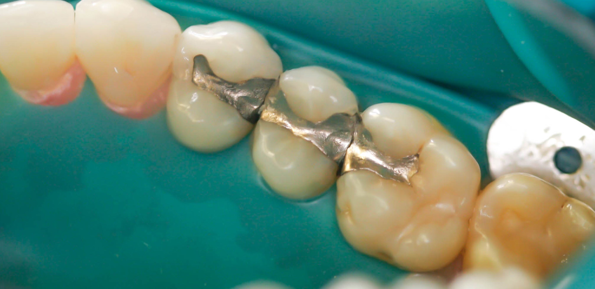 Safe amalgam or mercury filling removal and replacement with biocompatible tooth colored fillings -- the Before picture