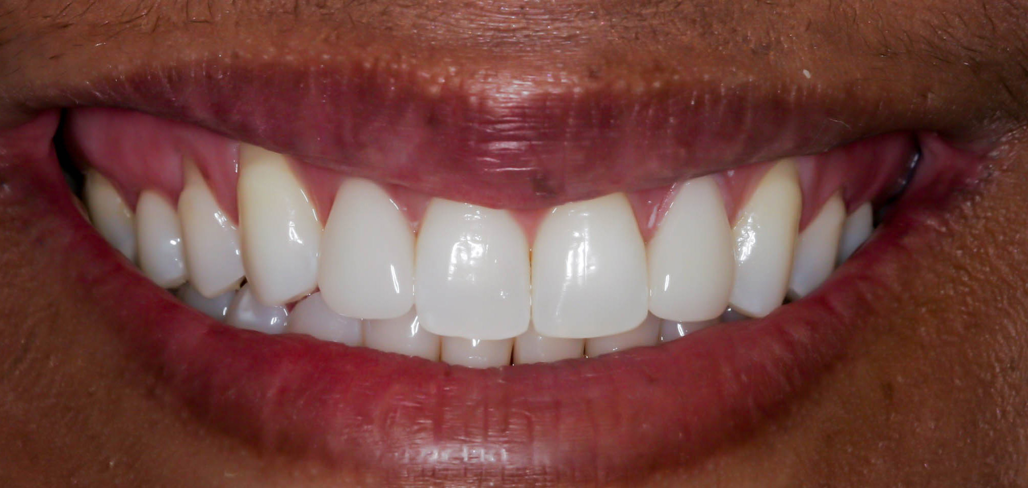 Single crown to enhance the smile -- the After photo
