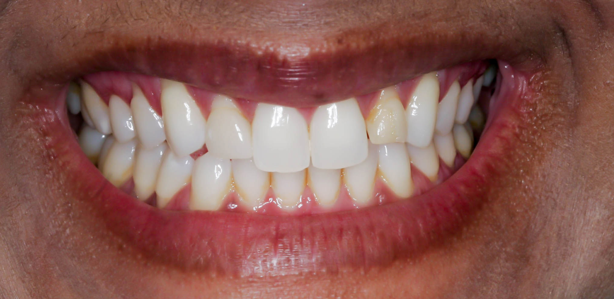 Single crown to enhance the smile -- the Before photo