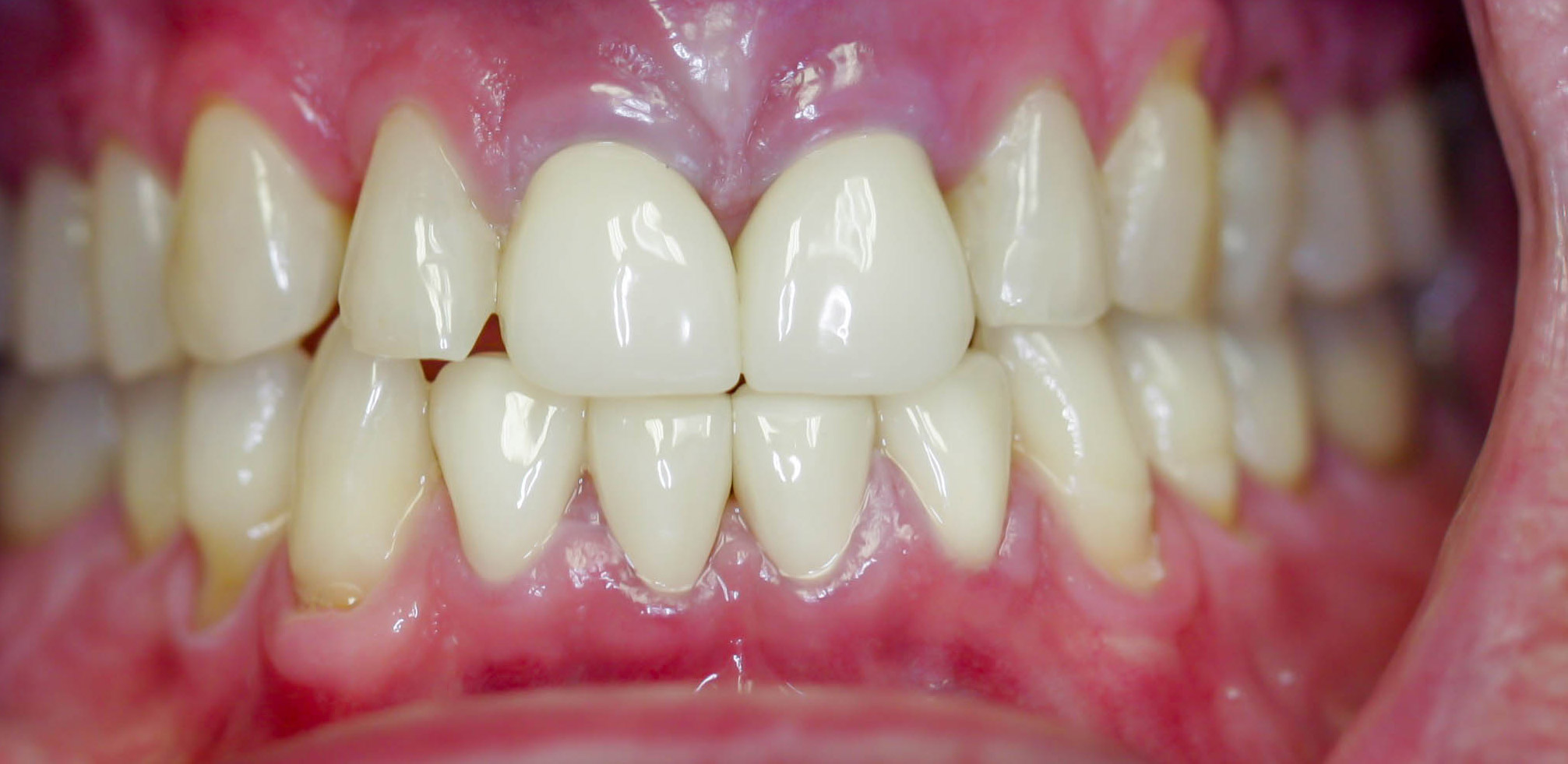 Smile makeover with crowns -- the After picture