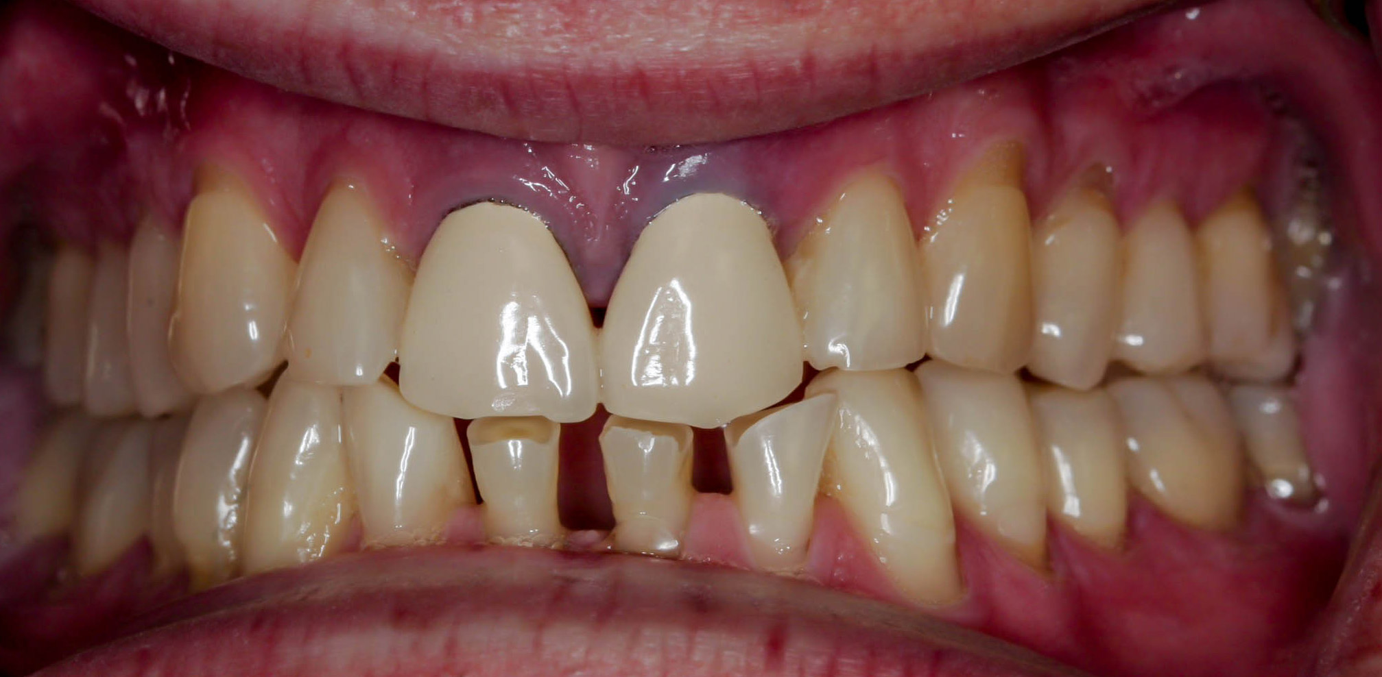 Smile makeover with crowns -- the Before picture