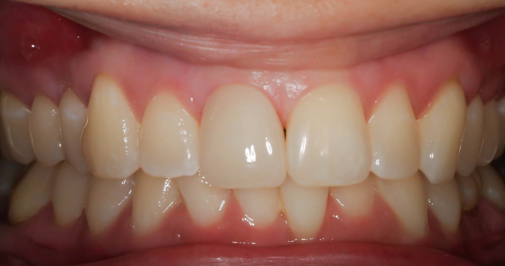 Single tooth crown to enhance esthetics -- the After photo