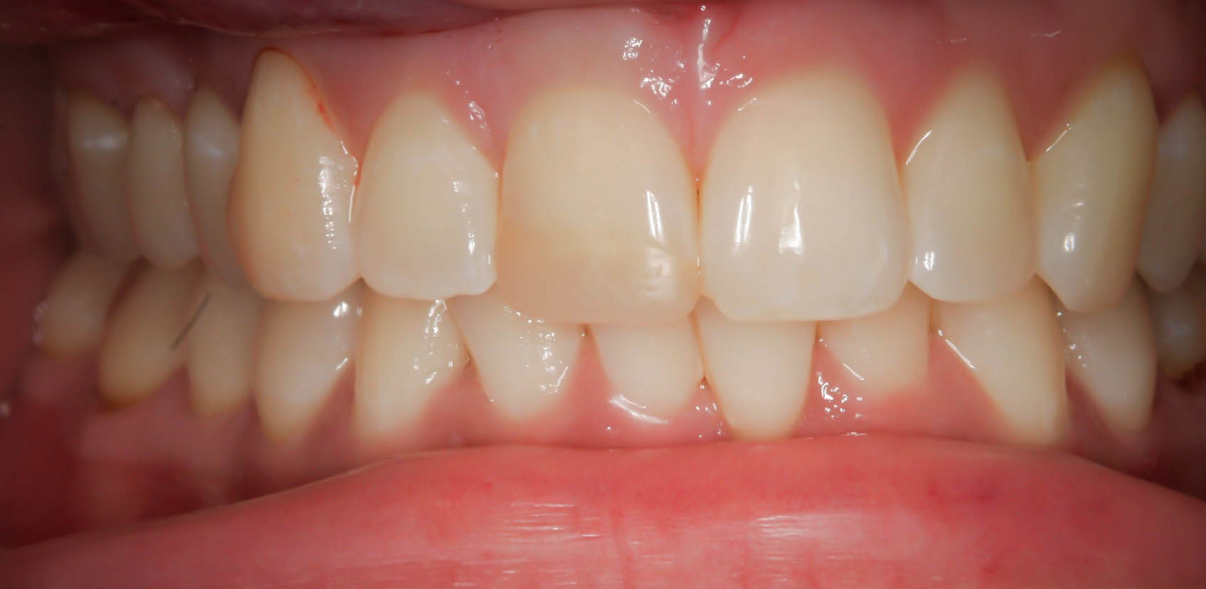 Single tooth crown to enhance esthetics -- the Before photo