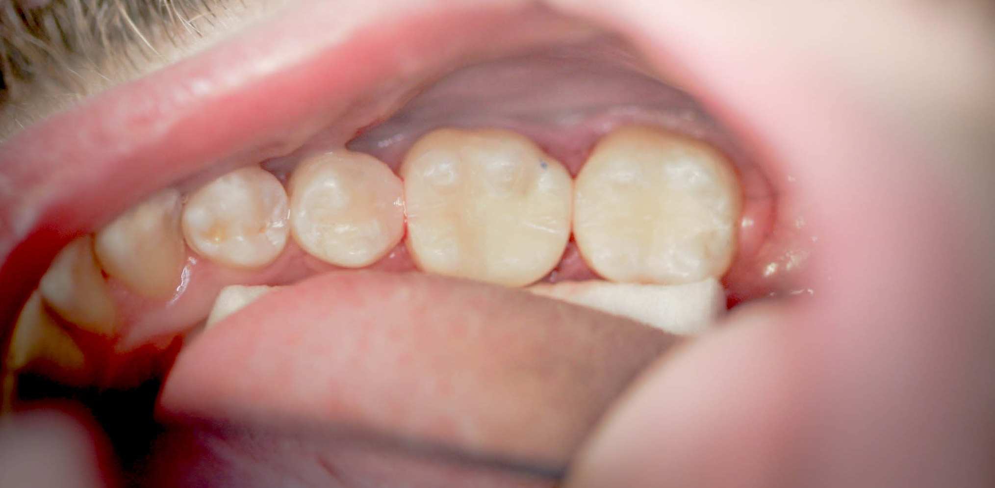Tooth colored fillings -- the After picture