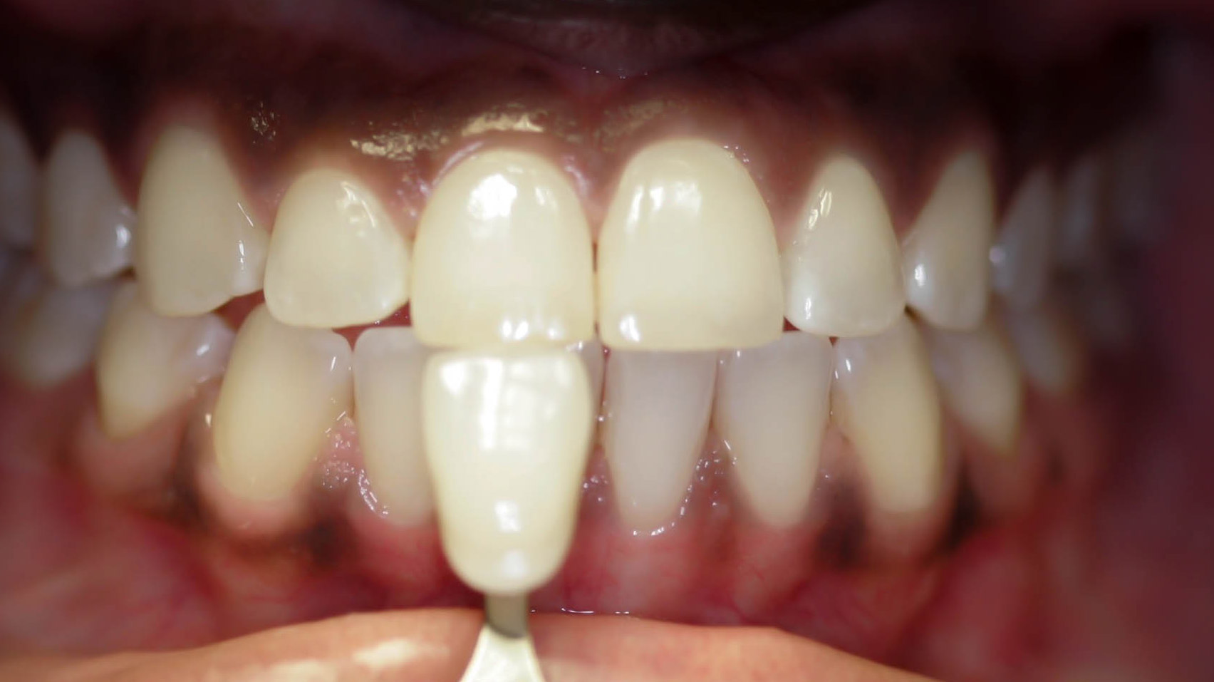Zoom whitening - the Before picture
