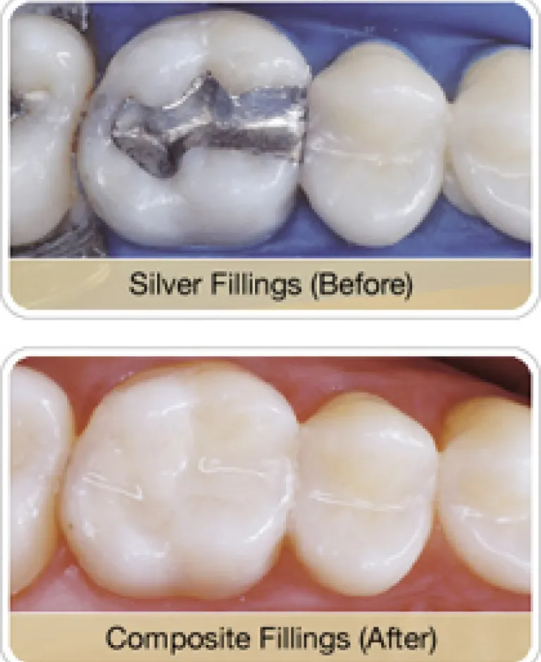 Safe Mercury Amalgam Fillings Removal Dentist